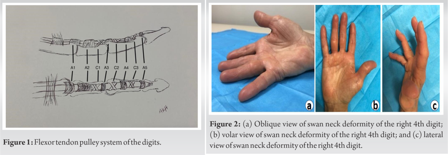 Swan Toe Swan Neck Deformity: An Unusual Complication Following Trigger Finger ...