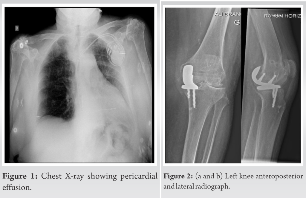 Septic Metallosis after Knee Replacement A Case