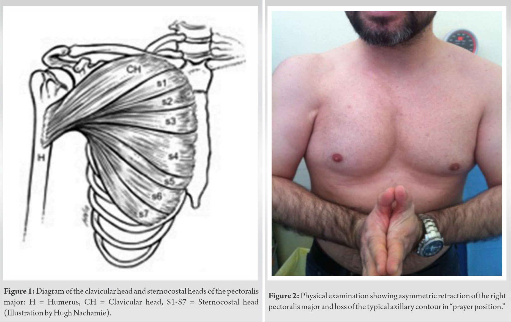 chronic-rupture-of-pectoralis-major-muscle-repair-a-surgical-case