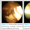 Arthroscopic Management of Pigmented Villonodular Synovitis of the Knee Joint