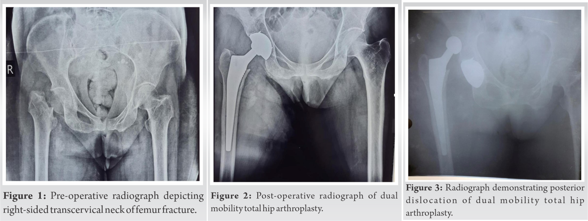 Intraprosthetic Dislocation Of Dual Mobility Total Hip Arthroplasty A Case Report And Review Of 6191