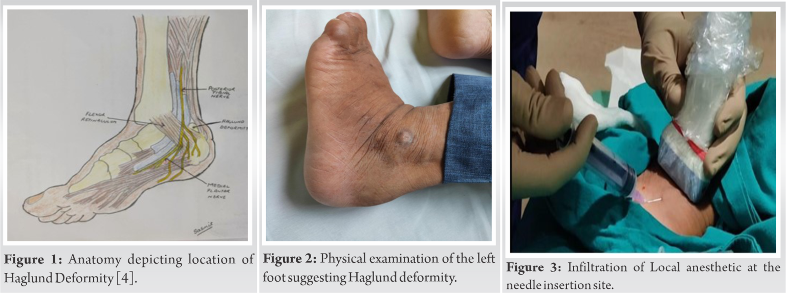 Haglund Incision Heel Pain Management in Haglund’s Deformity Targeting Sural Nerve ...