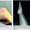 Management of Forearm Deformity by Limb Reconstruction System in Children with Multiple Exostosis – A case Report
