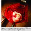 Femoral Head Reduction Osteotomy for Deformed Perthes Head Using Ganz Safe Surgical Dislocation of Hip – A Case Report with 3-Year Follow-up