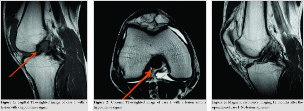 Fig 1 2 3 | Journal of Orthopaedic Case Reports