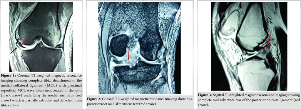 Fig-1-2-3-188 | Journal of Orthopaedic Case Reports