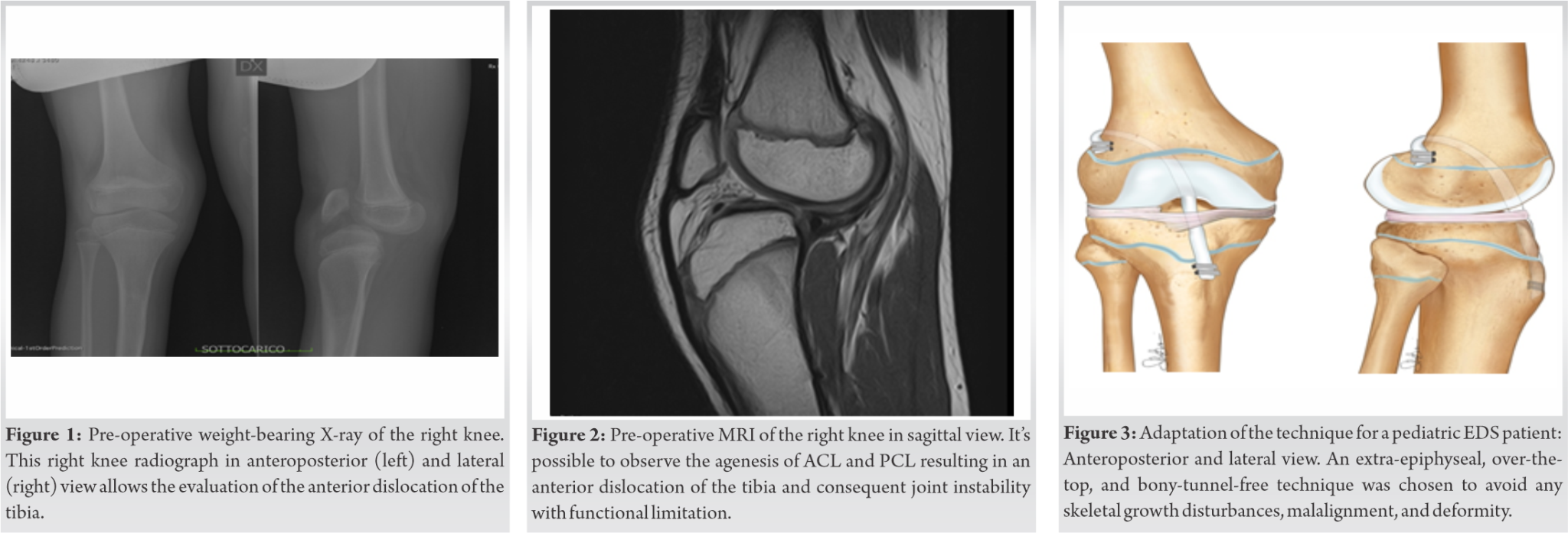Fig 1 2 3 Journal Of Orthopaedic Case Reports fig-1-2-3-journal-of-orthopaedic-case-reports