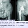 Bilateral Rapidly Destructive Osteoarthritis of the Hip: Could We be Misdiagnosing? A Case Report