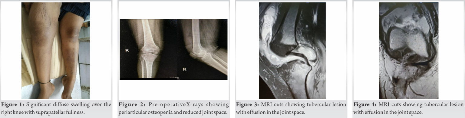 fig-1-2-3-4-journal-of-orthopaedic-case-reports