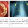 Cleidocranial Dysplasia: A Clinico-radiographic Spectrum with Differential  Diagnosis