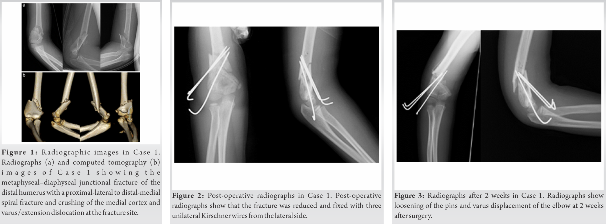 Fig 1 2 3 Journal Of Orthopaedic Case Reports fig-1-2-3-journal-of-orthopaedic-case-reports
