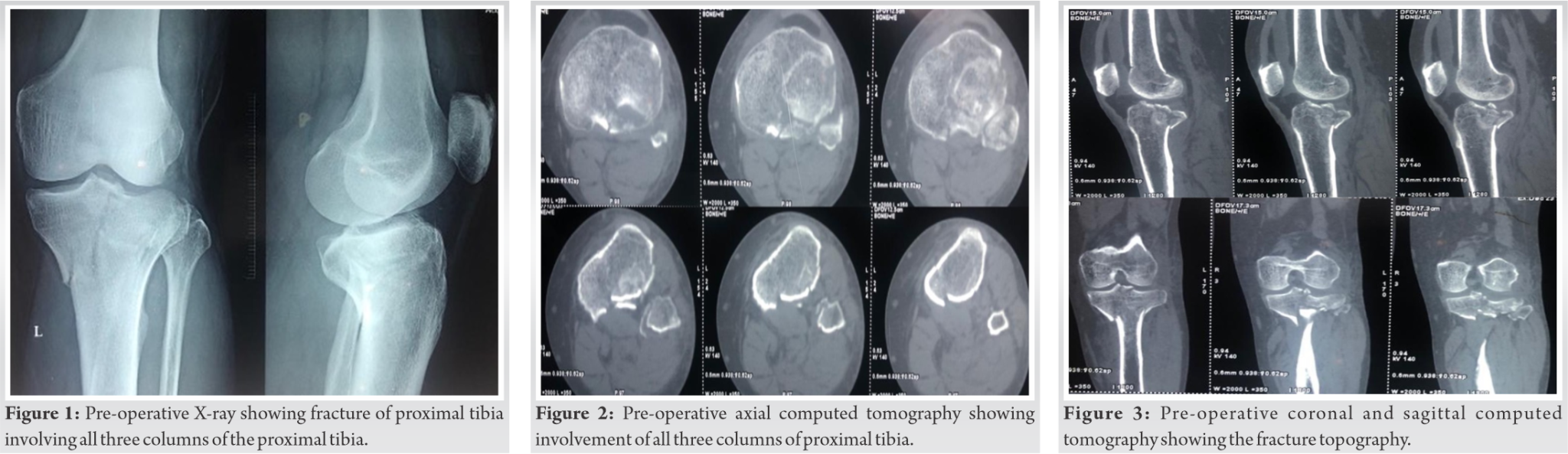 Fig 1 2 3 Journal Of Orthopaedic Case Reports fig-1-2-3-journal-of-orthopaedic-case-reports