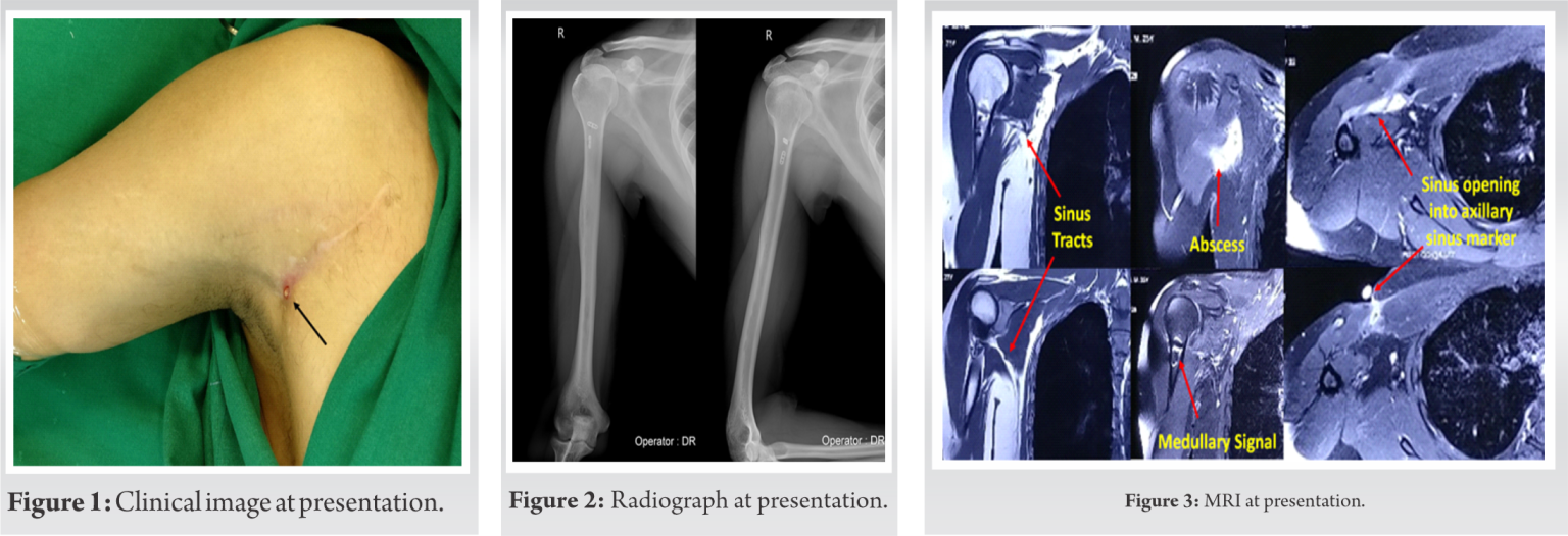 Fig 1 2 3 Journal Of Orthopaedic Case Reports fig-1-2-3-journal-of-orthopaedic-case-reports
