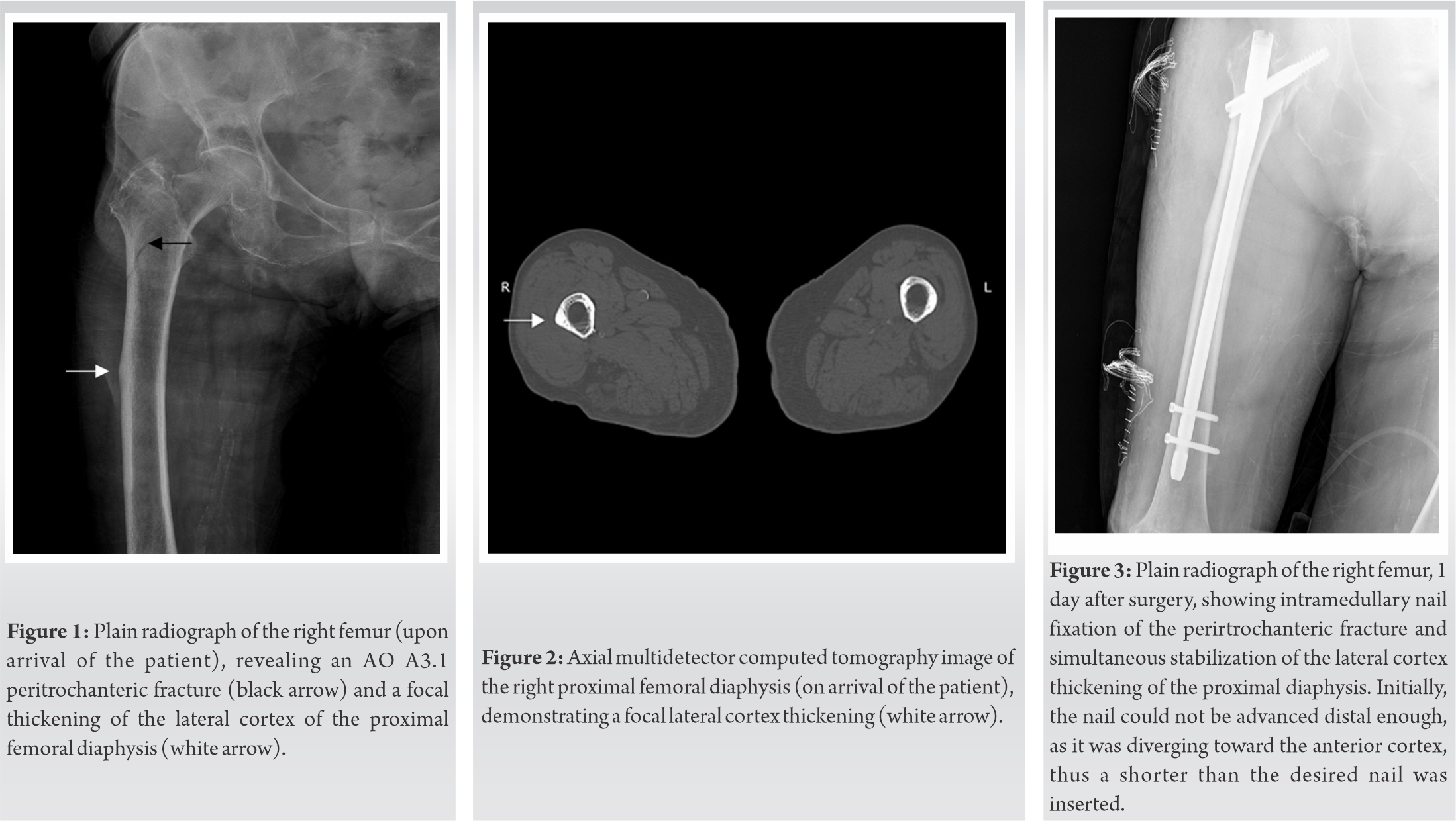 Fig 1 2 3 | Journal Of Orthopaedic Case Reports