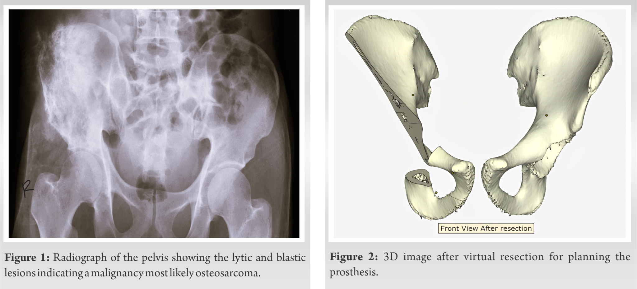 Tailored Precision: A Unique Case of Pelvic Osteosarcoma Management ...