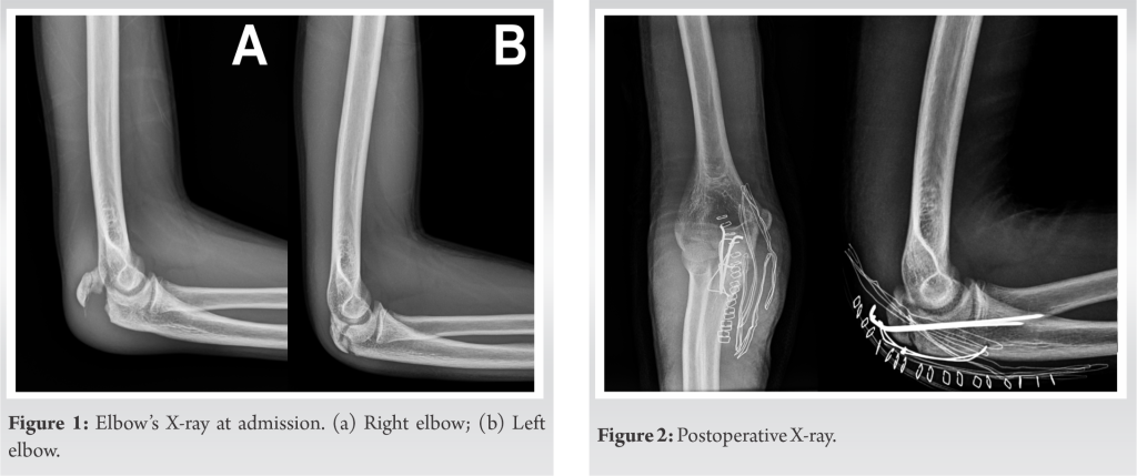 Bilateral Synchronous Olecranon Apophyseal Fracture in a Teenager: A ...