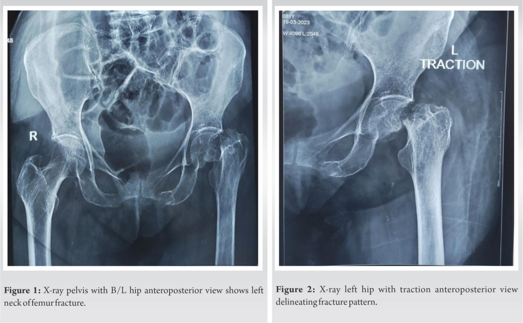 Hip Fracture in a Patient with Overlap Syndrome – Conundrums Involved ...