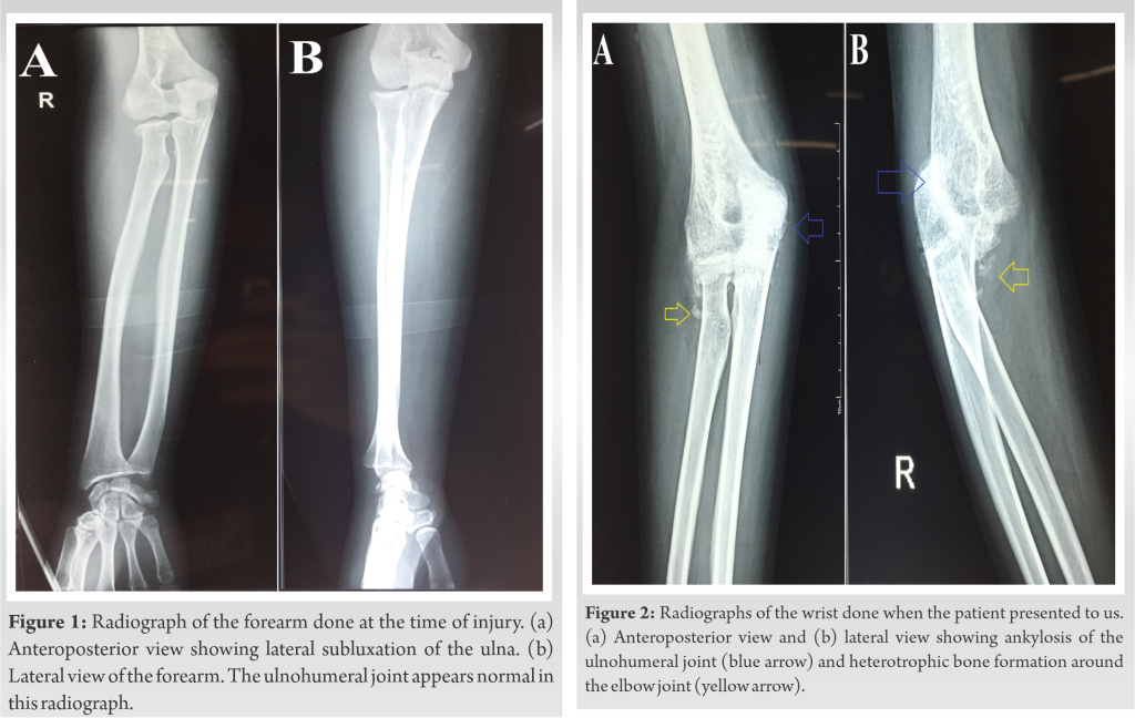 Neglected Elbow Dislocation Leading To Ankylosis Of Elbow: A Case ...