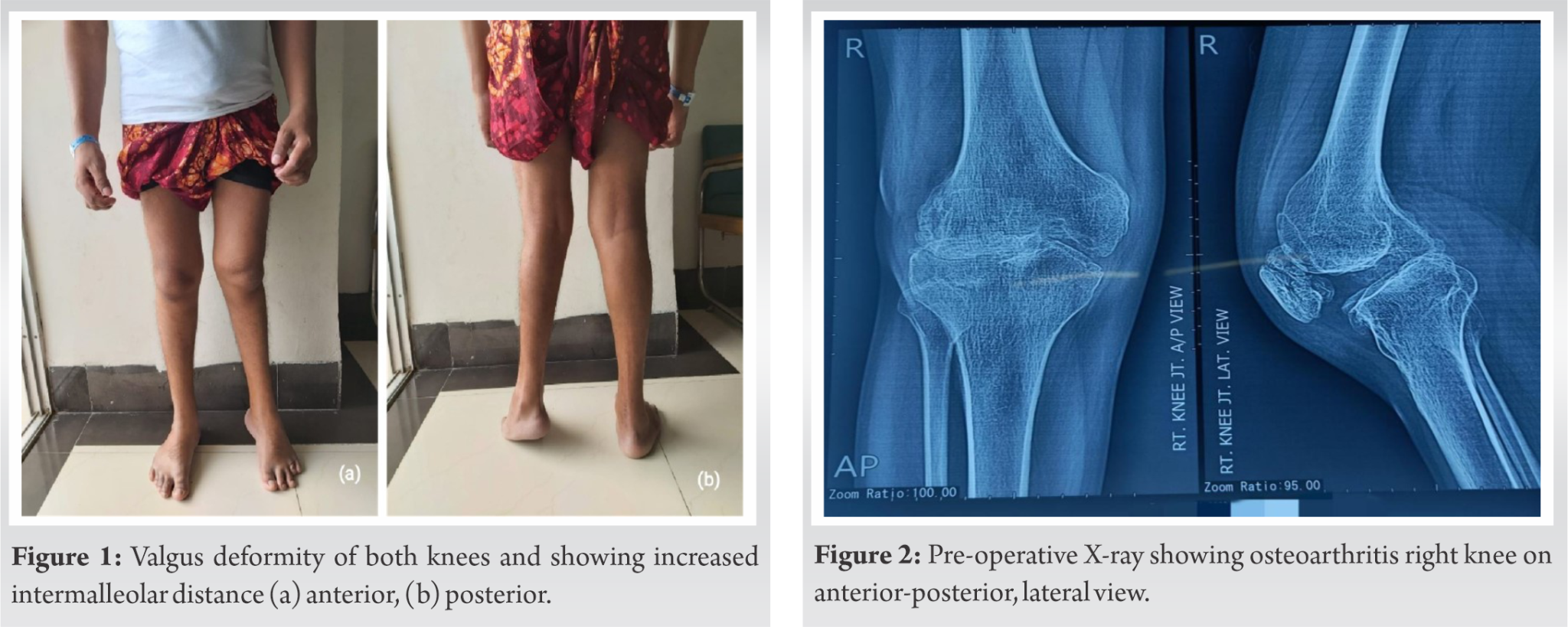 Total Knee Replacement in a Young Patient with Valgus Knee ...