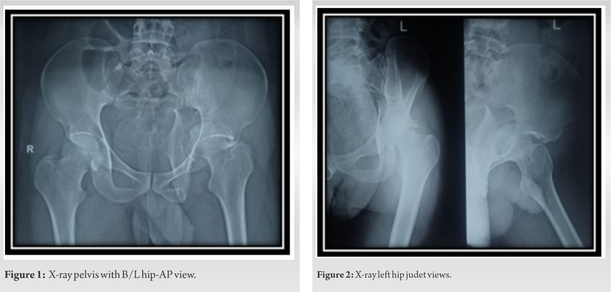 From Trauma to Triumph: Navigating the Complexities of a Central Hip ...