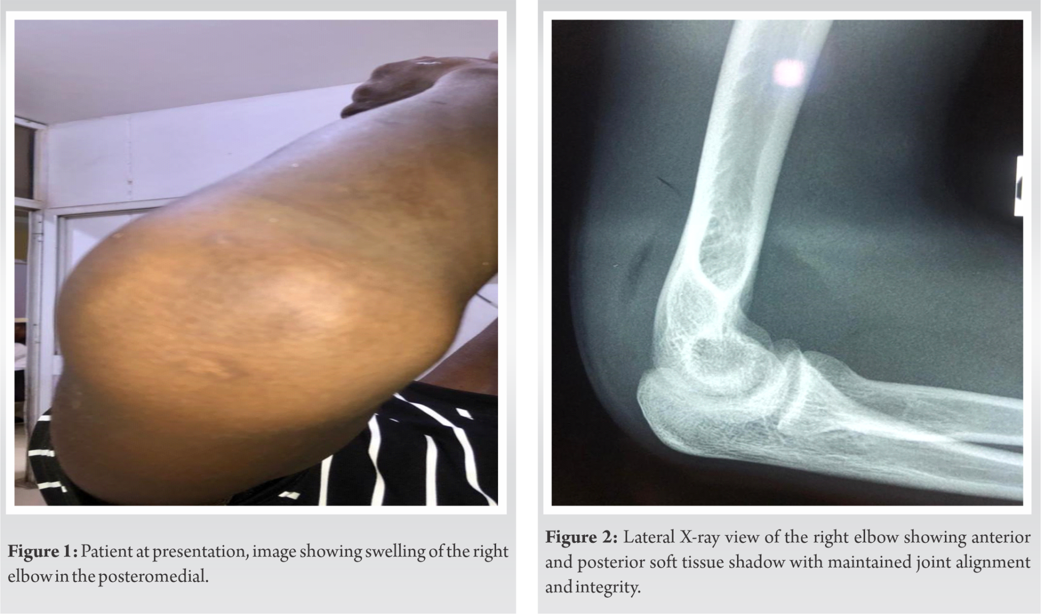 A Rare Case of Idiopathic Elbow Septic Arthritis in an Adult | Journal ...