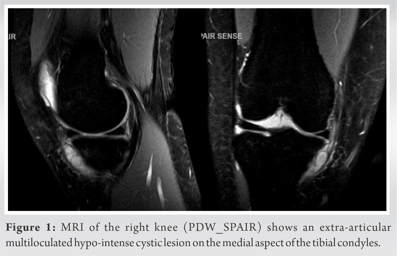 A Rare Case of Synovial Chondromatosis of Knee with both Intra ...