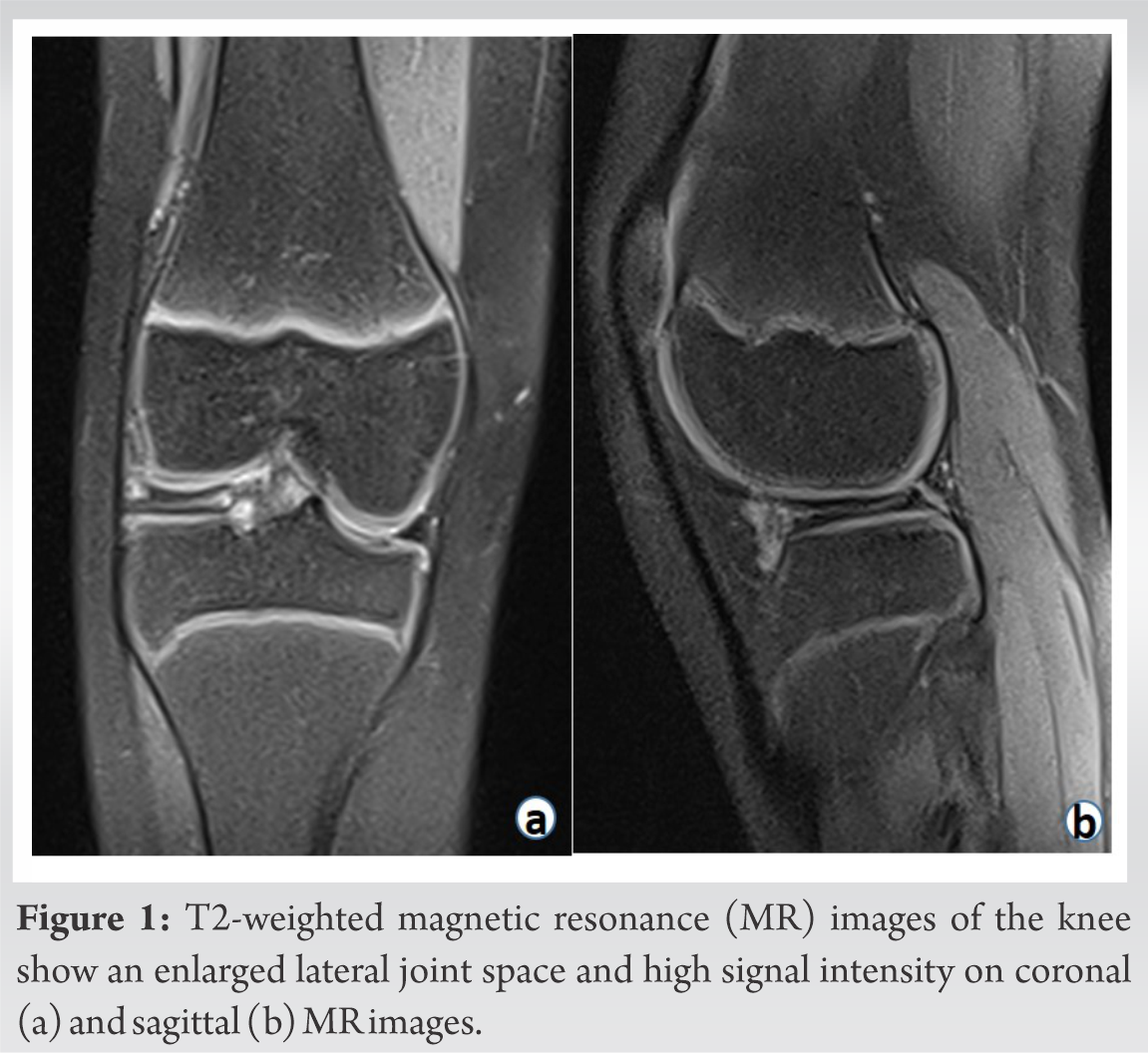 Discoid Double-layered Lateral Meniscus: A Case Report | Journal of ...