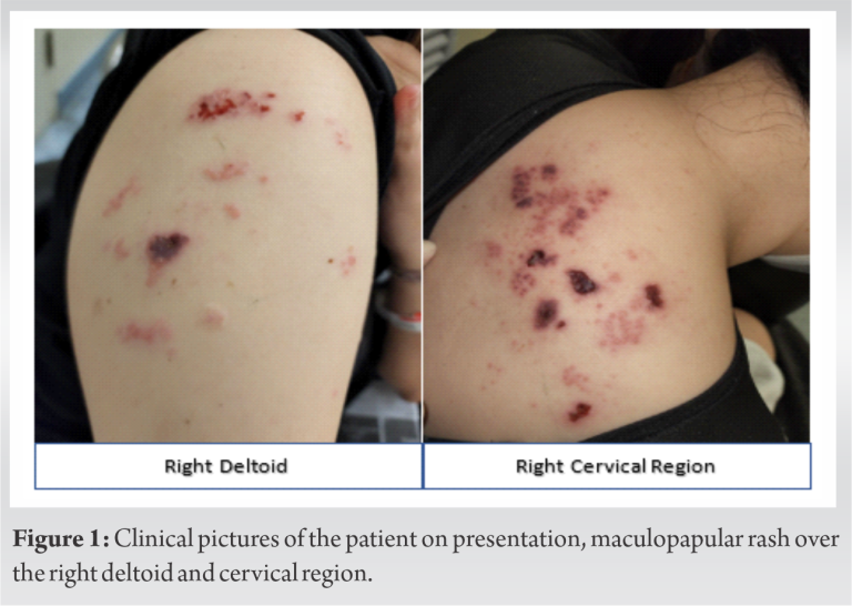 Case Report of Herpes Zoster Infection of the Cervical Dermatome – A ...