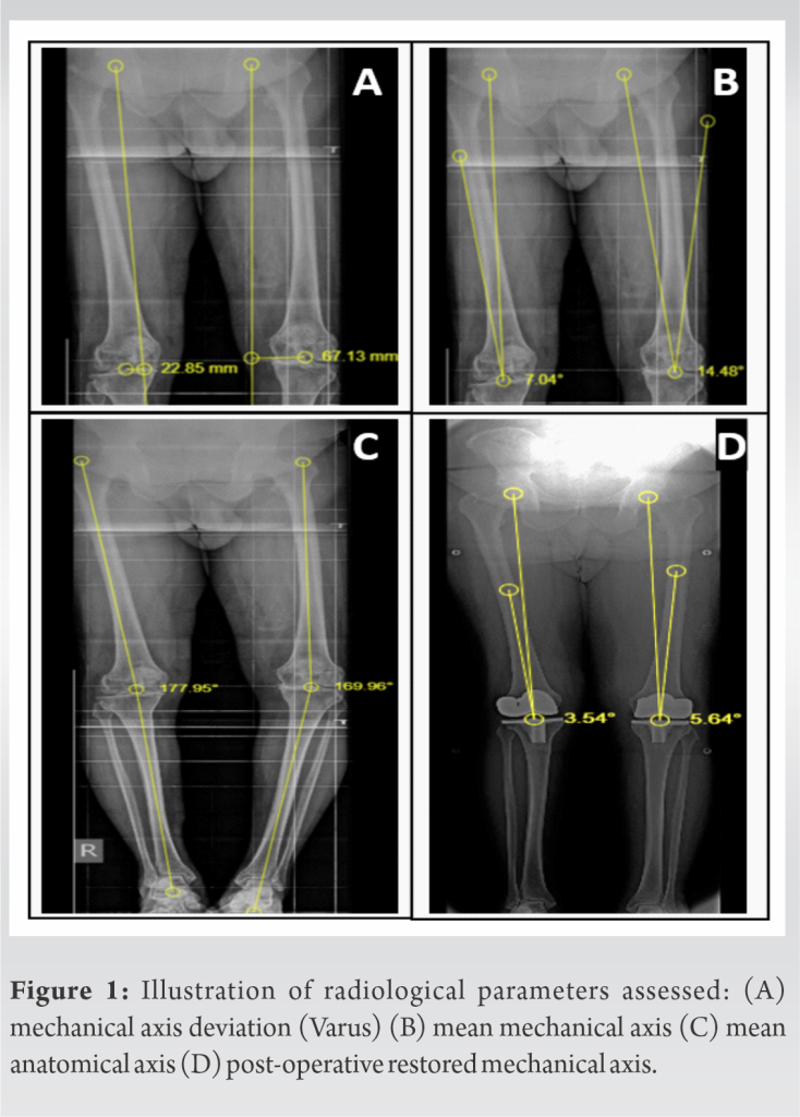 Functional and Radiological Outcome of Simultaneous Bilateral Total ...