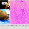 The Limb beyond Salvage: A Case Report on Two Cases of Fibroblastic Variants of Osteosarcoma