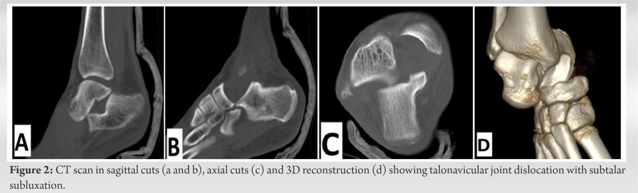 Medial Swivel Dislocation of the Talonavicular Joint Due to High-Energy ...