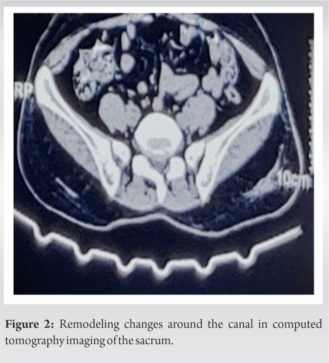 Conservative Management of Symptomatic Sacral Tarlov Cyst A Rare Case