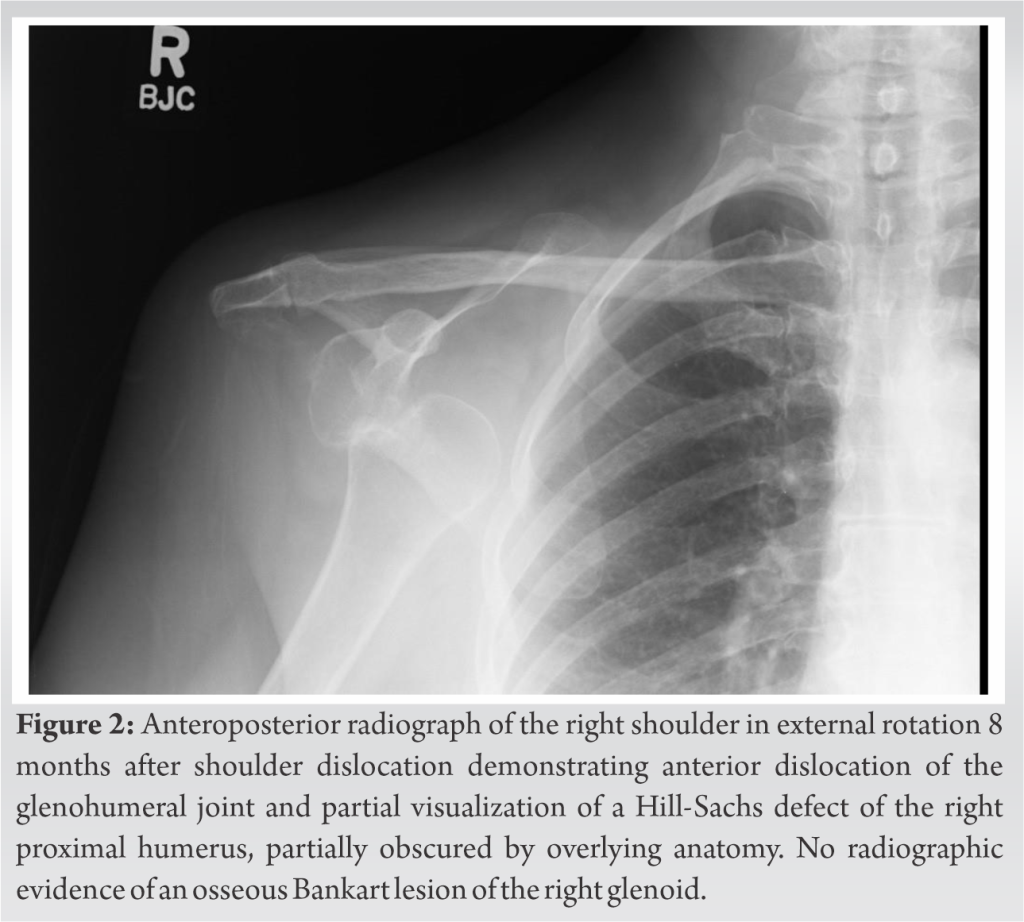 Rare Case of Chronic Unreduced Shoulder Dislocation: A Case Report and ...