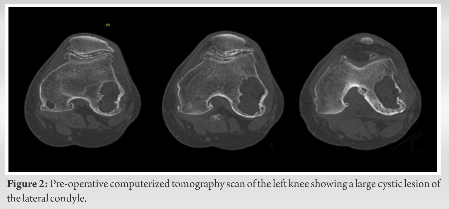 Management of a Massive Solitary Femoral Condyle Bone Cyst at the Site ...