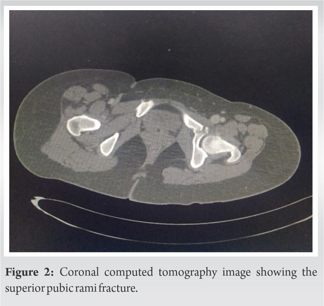Bilateral Floating Knee Injuries Managed by Intramedullary Nailing – An ...