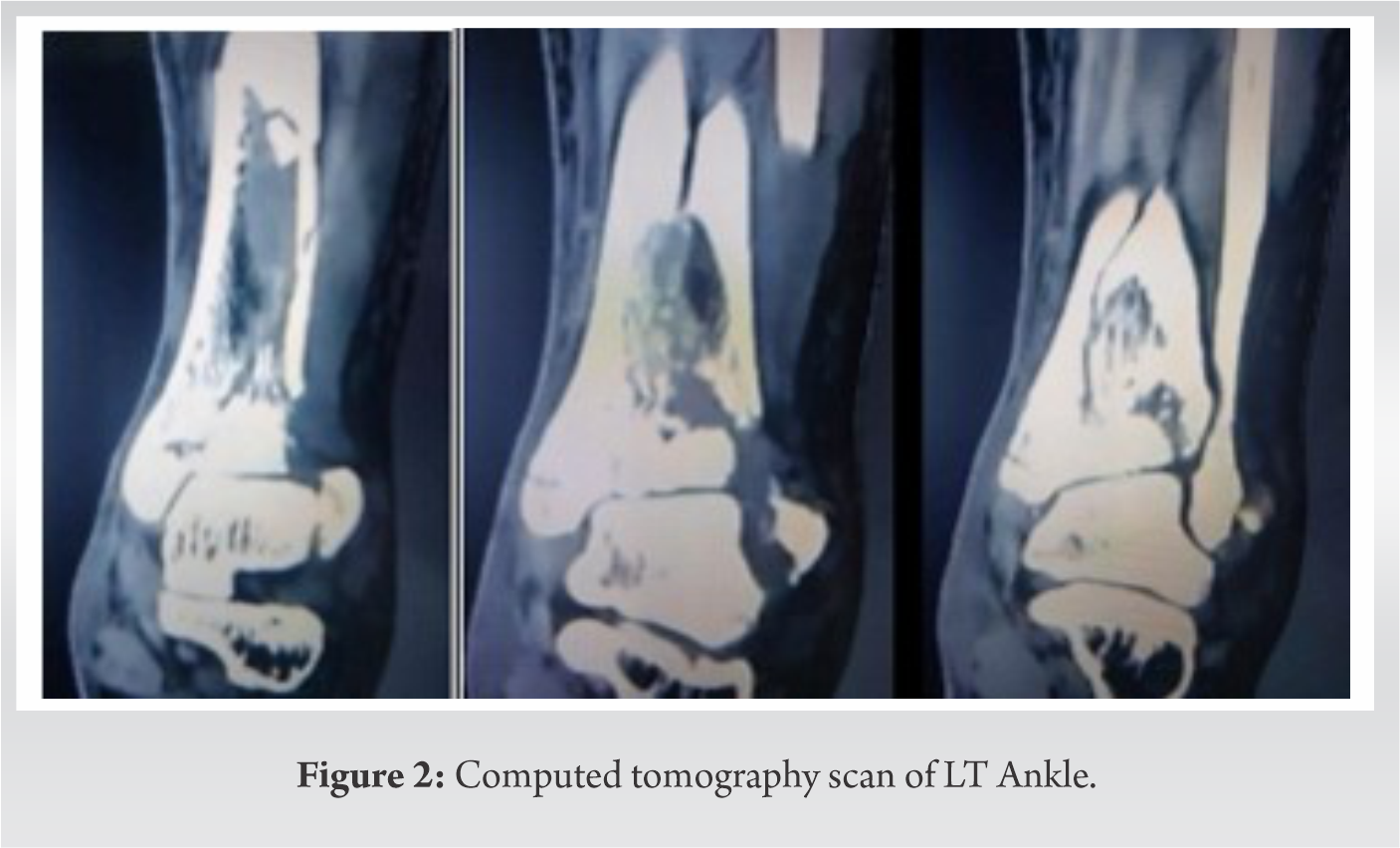 Case Report: A Rare Case Of Bilateral Tibial Plafond Fracture In A ...