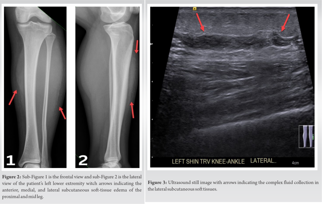 Delayed Onset Of Pediatric Morel Lavall e Lesion A Case Report