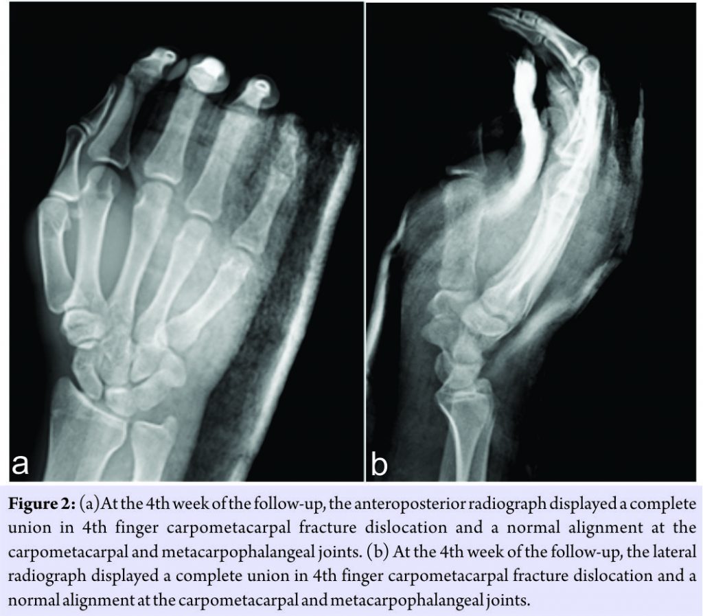 Simultaneous Metacarpophalangeal Dislocation and Carpometacarpal ...