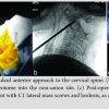 Operative Intervention for a Chronic Fifth Carpometacarpal Dislocation: A Case Report and Review of Literature