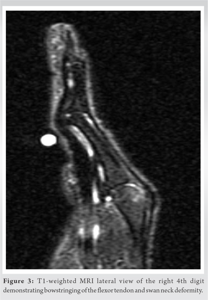 Swan Neck Deformity: An Unusual Complication Following Trigger Finger ...