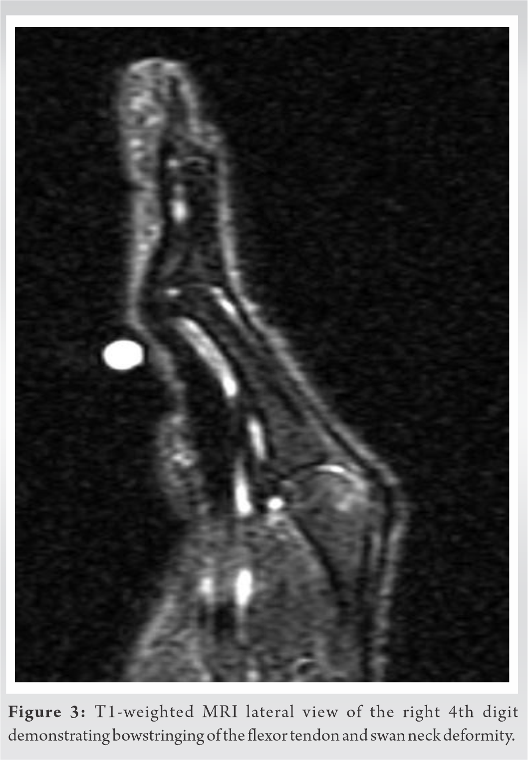 Swan Neck Deformity An Unusual Complication Following Trigger Finger