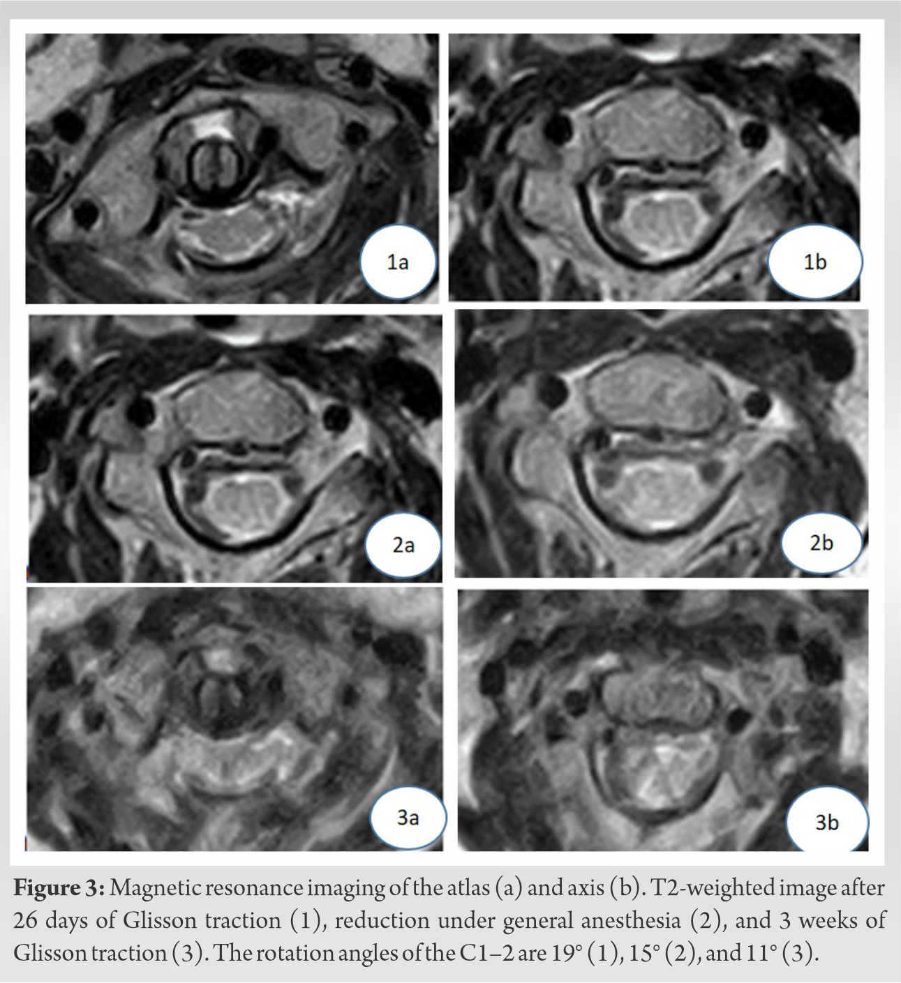 Atlantoaxial Instability after Treatment of Atlantoaxial Rotatory ...