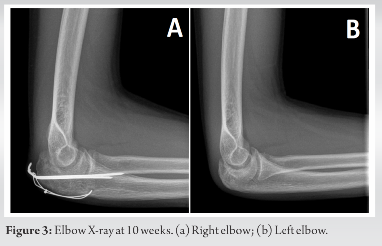 Bilateral Synchronous Olecranon Apophyseal Fracture in a Teenager: A ...