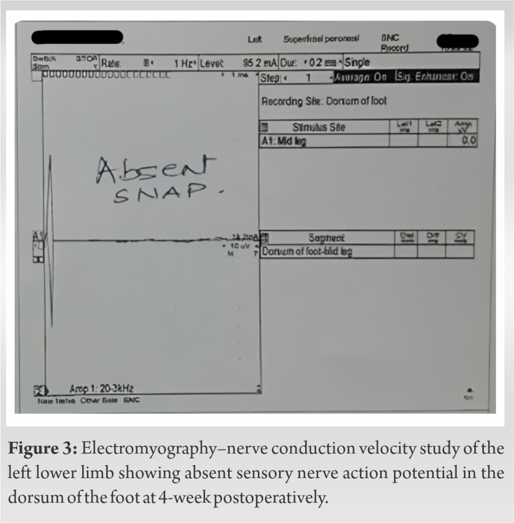 Delayed Recovery Of Idiopathic Common Peroneal Nerve Palsy After Total 