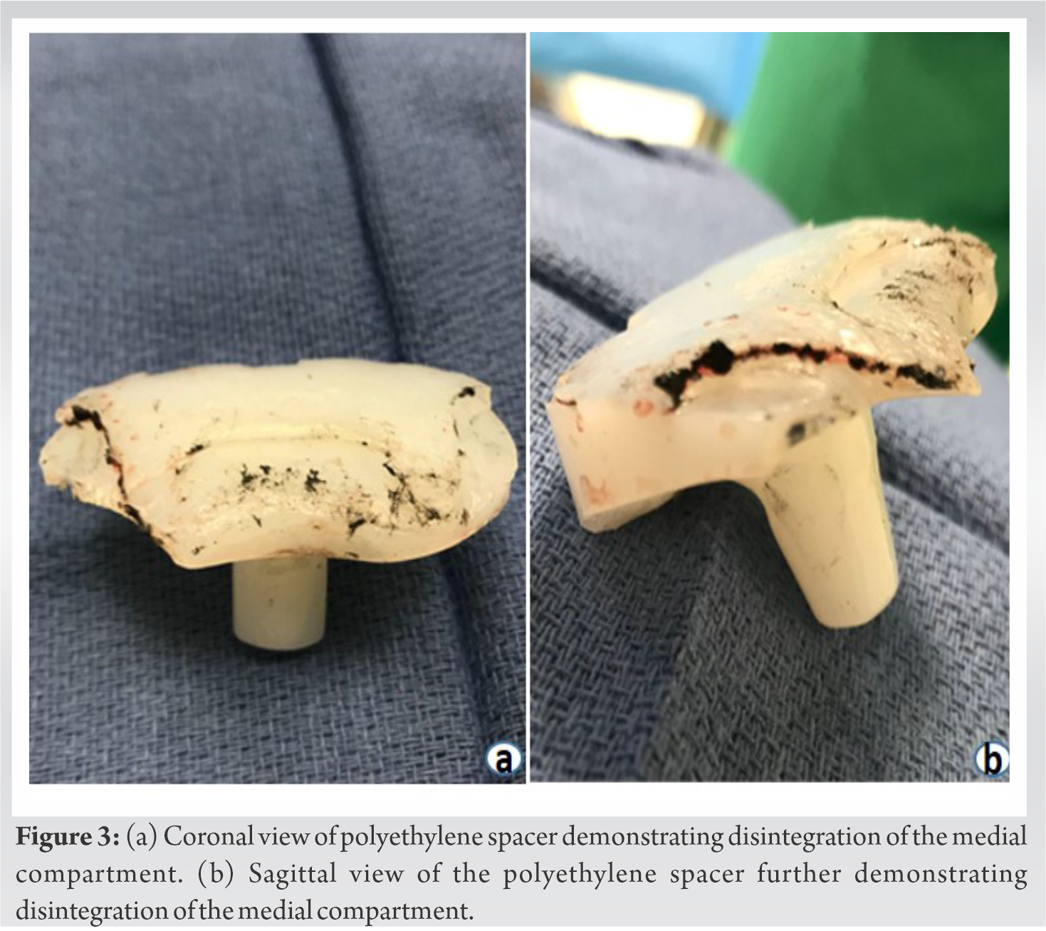 Oxidized Zirconium Bearing Surface Failure in Total Knee Arthroplasty