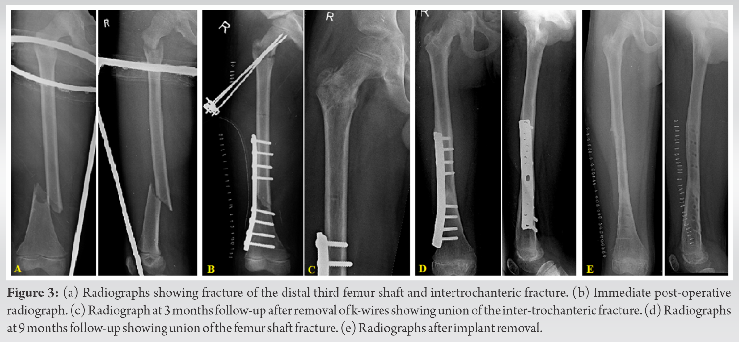 JCDR - Diaphyseal fractures, Femur, K-wire, TENS nail