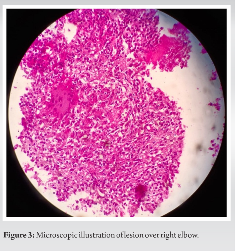 Tubercular Osteomyelitis Mimic Ewing’s Sarcoma | Journal of Orthopaedic ...