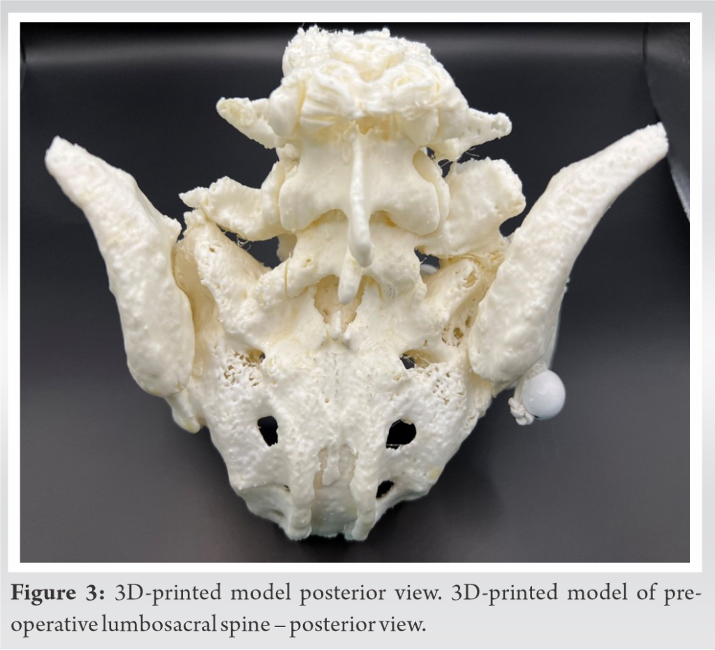 3D-Printed Spine Models for Planning Staged Minimally Invasive ...