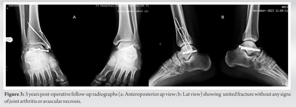 Optimizing Orthopedic Outcomes in Complex Bilateral Talus Fracture ...