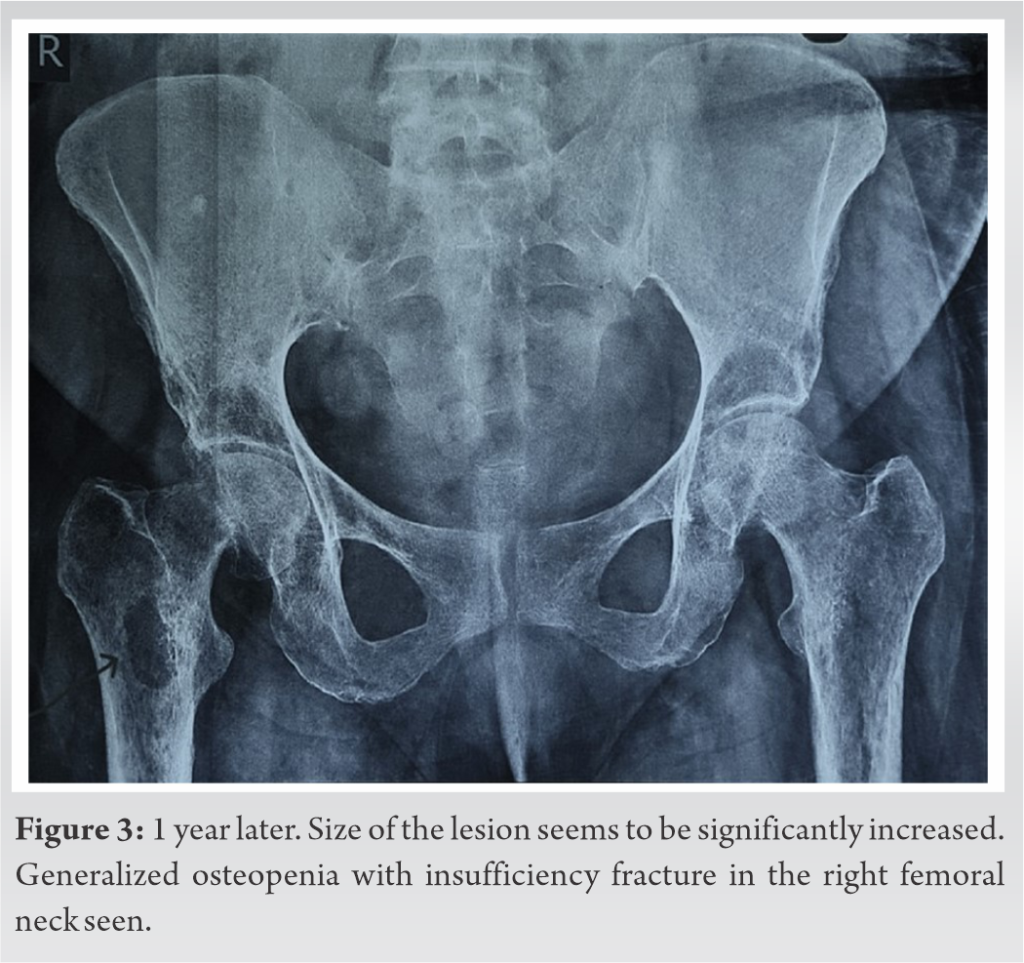 Phosphaturic Mesenchymal Tumor in the Proximal Femur Presenting as ...